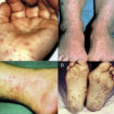 meningococcal infections