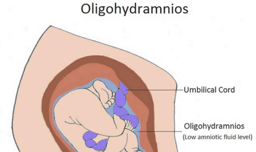 oligohydramnios