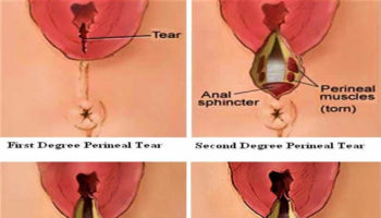 perineal-tear