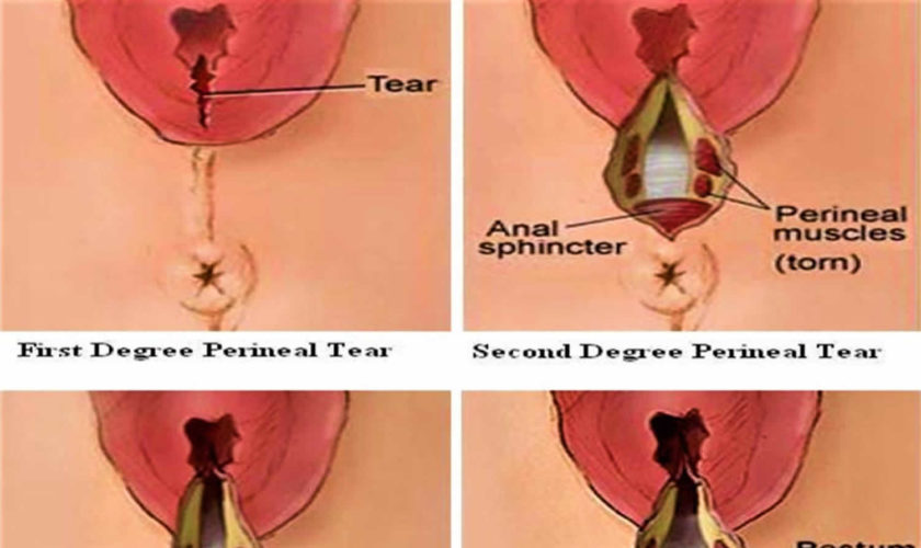 perineal-tear