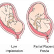 placenta-previa