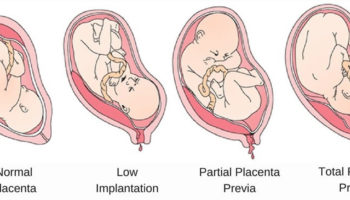 placenta-previa