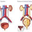 posterior urethral valves