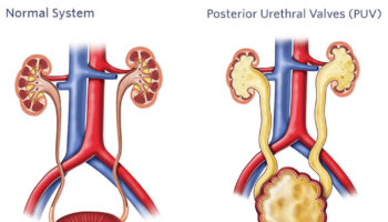 posterior urethral valves