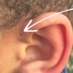 preauricular-sinus