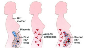 Rhesus disease