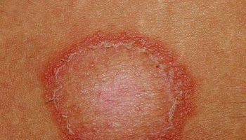 ringworm in babies