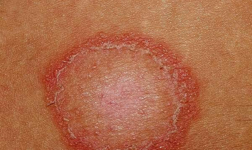 ringworm in babies