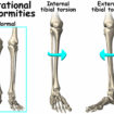 tibial torsion