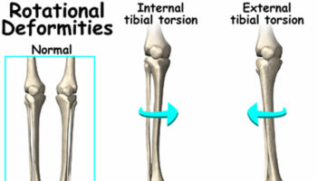 tibial torsion