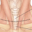 tracheal stenosis