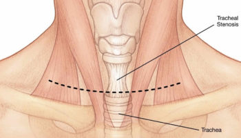 tracheal stenosis