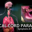 vocal-cord-paralysis