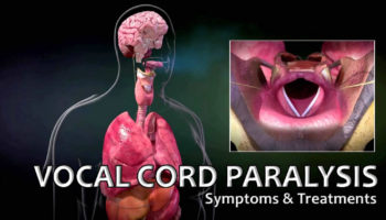 vocal-cord-paralysis