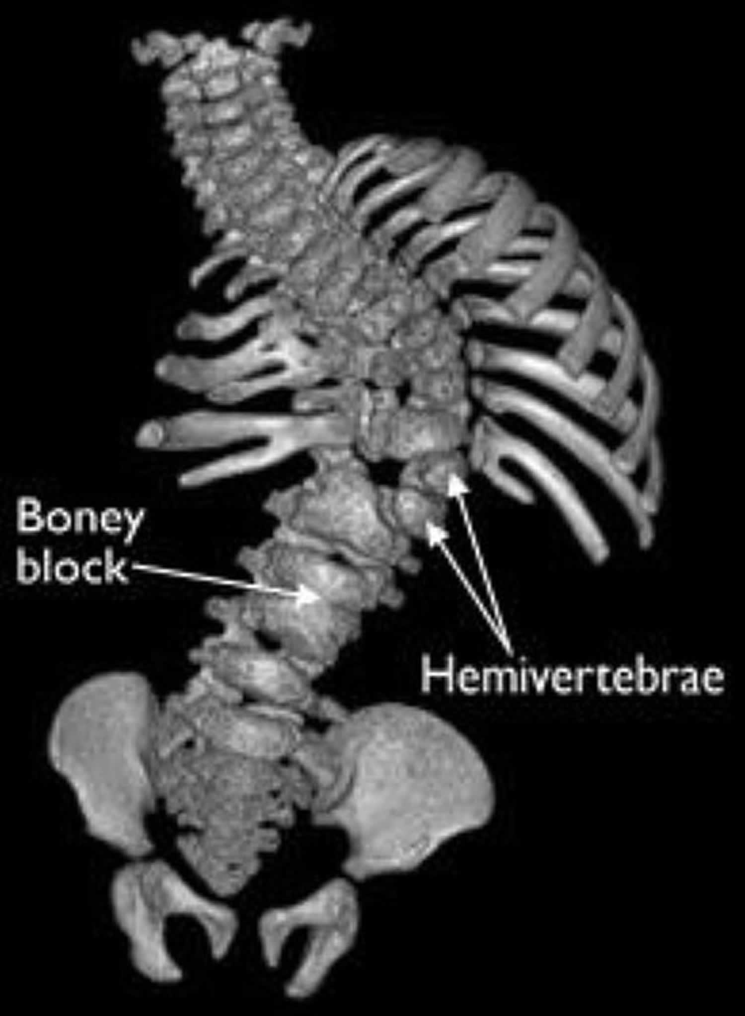 CT scan of hemivertebrae scoliosis