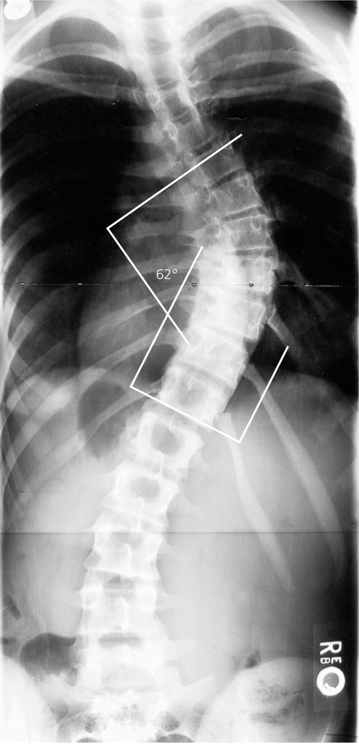 Cobb angle of scoliosis
