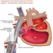 Fontan procedure