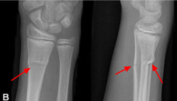 Greenstick-fracture