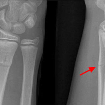 Greenstick-fracture