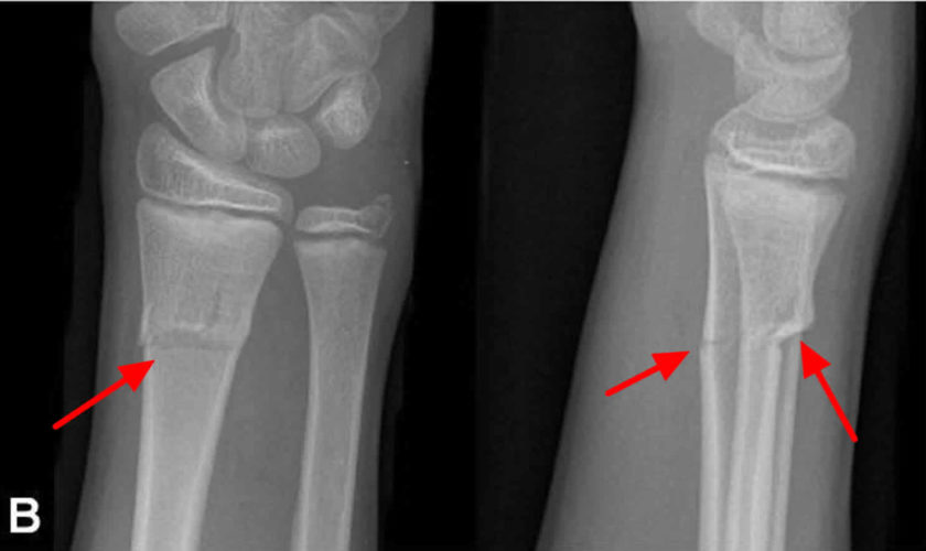 Greenstick-fracture