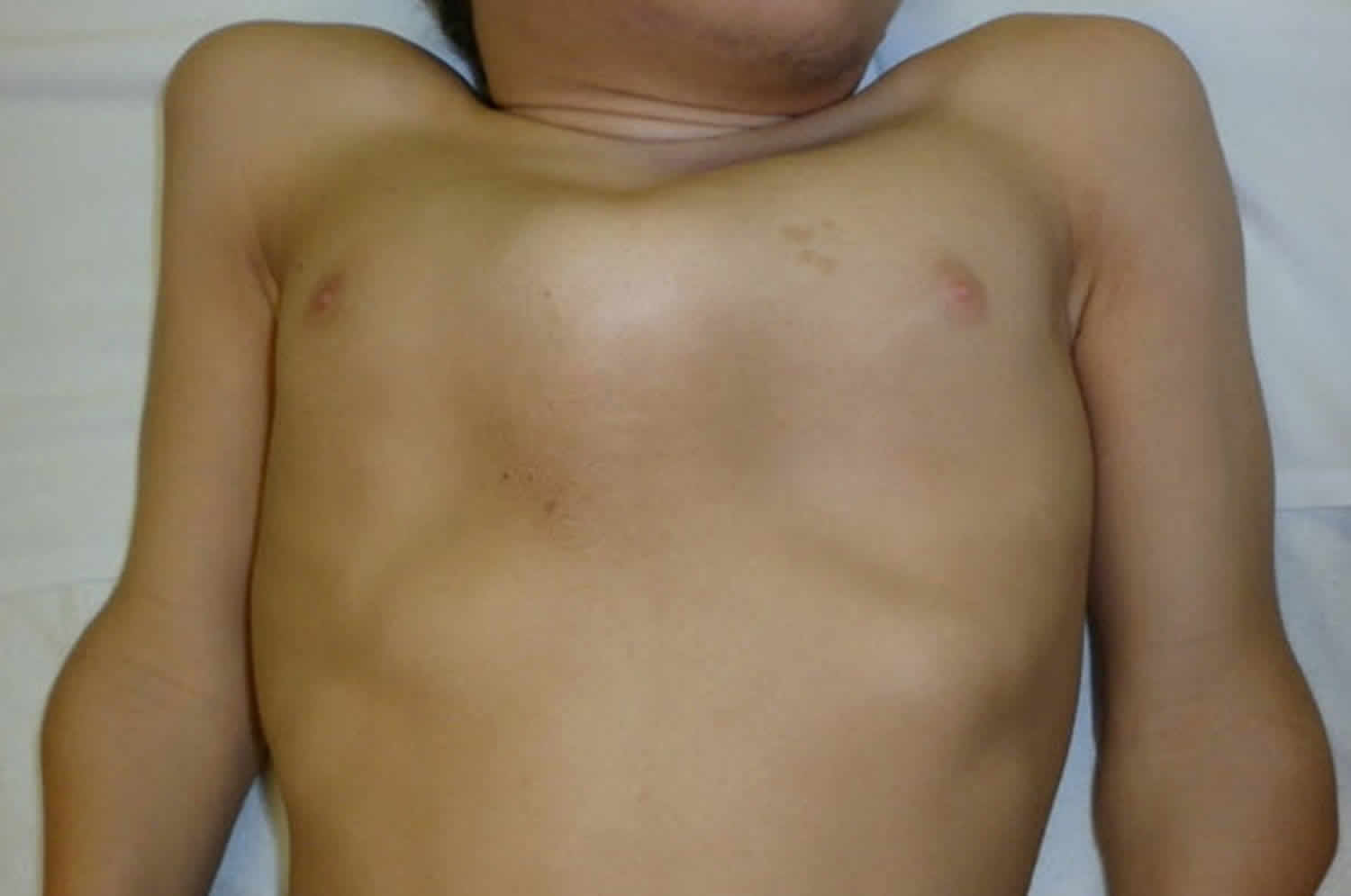 Morquio syndrome with pectus anomaly and short neck in a male