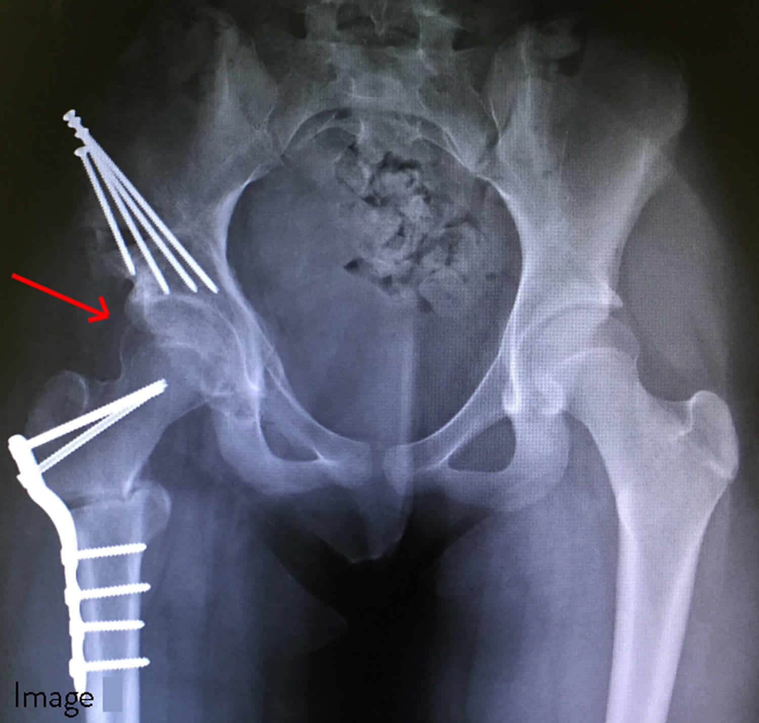 Periacetabular osteotomy combined with a femoral osteotomy for acetabular dysplasia
