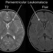 Periventricular leucomalacia