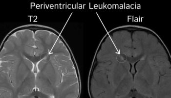 Periventricular leucomalacia