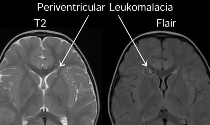 Periventricular leucomalacia