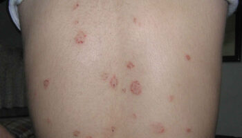 Pityriasis rosea in children