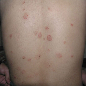 Pityriasis rosea in children