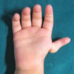 Thumb hypoplasia