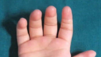 Thumb hypoplasia