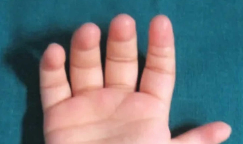 Thumb hypoplasia