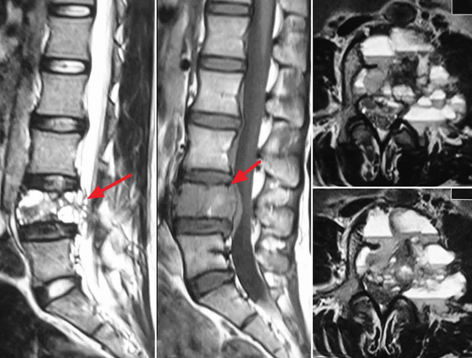 Aneurysmal bone cyst spine