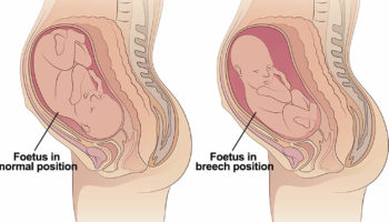 breech-baby