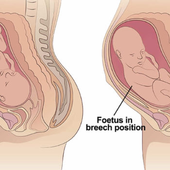 breech-baby