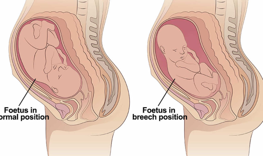 breech-baby