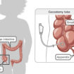 cecostomy tube