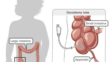 cecostomy tube