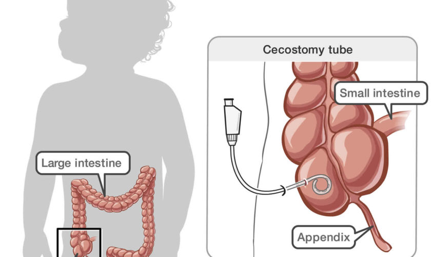 cecostomy tube