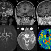 central nervous system vasculitis