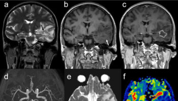 central nervous system vasculitis