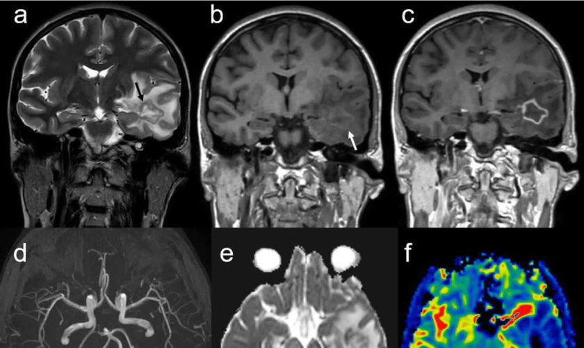 central nervous system vasculitis