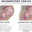 cervical incompetence