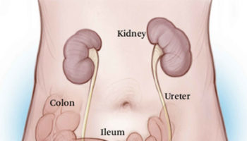 cystoplasty