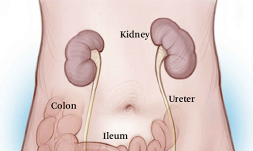 cystoplasty