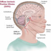 diffuse intrinsic pontine glioma