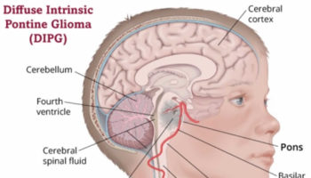 diffuse intrinsic pontine glioma