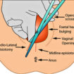 episiotomy